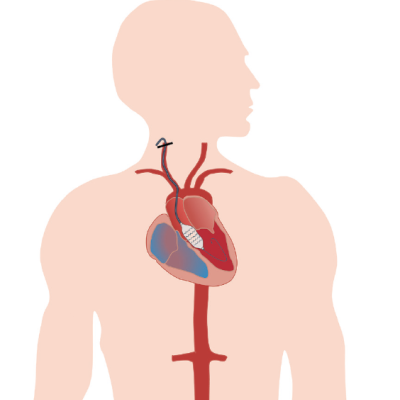 Transcarotid Transcatheter Aortic Valve Implantation