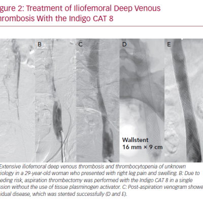 Treatment of Iliofemoral Deep Venous