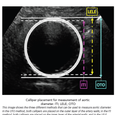 Different Methods That Can be Used to Measure Aortic Diameter