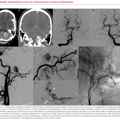 Radial Transradial Access for Arteriovenous Fistula Embolisation