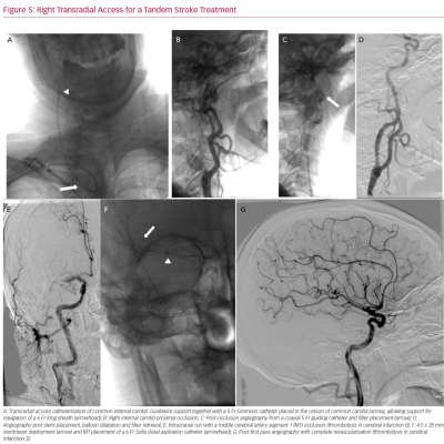 Right Transradial Access for a Tandem Stroke Treatment